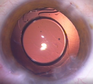 Difraktif halkaların olmadığı bir EDOF lensinin ameliyat sonunda göz içinde görünümü