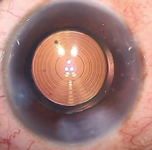 Trifokal lens takılmış bir gözde difraktif halkaların görünümü